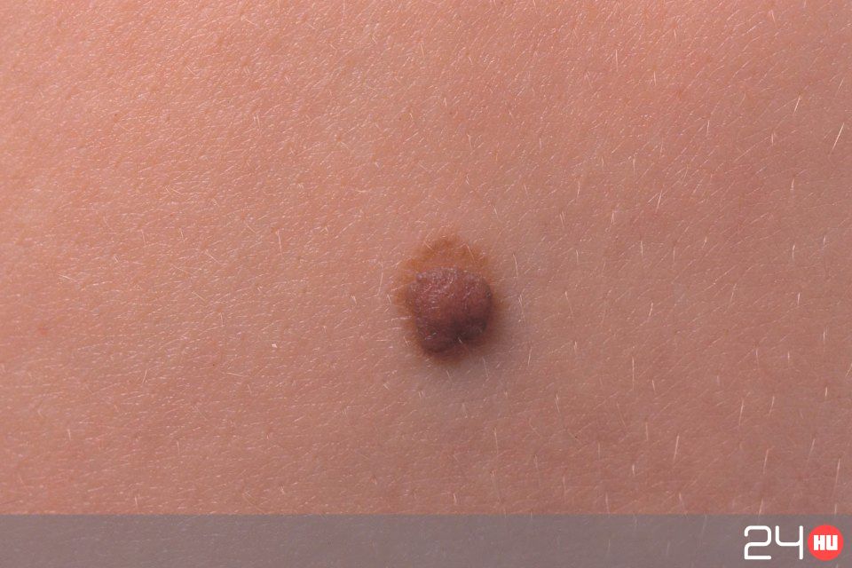 Szemölcsök és HPV - a bőrgyógyász válaszol