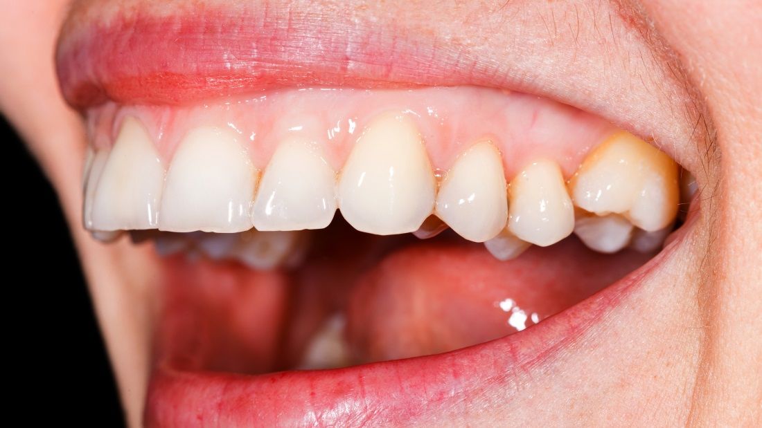 Merevedési zavart okozhat a gyulladt fogíny
