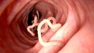 pinwormok akik felfedezték kijöhet e a féreg a szájon keresztül